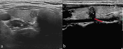 Nomogram for Preoperative Estimation of Cervical Lymph Node Metastasis Risk in Papillary Thyroid Microcarcinoma